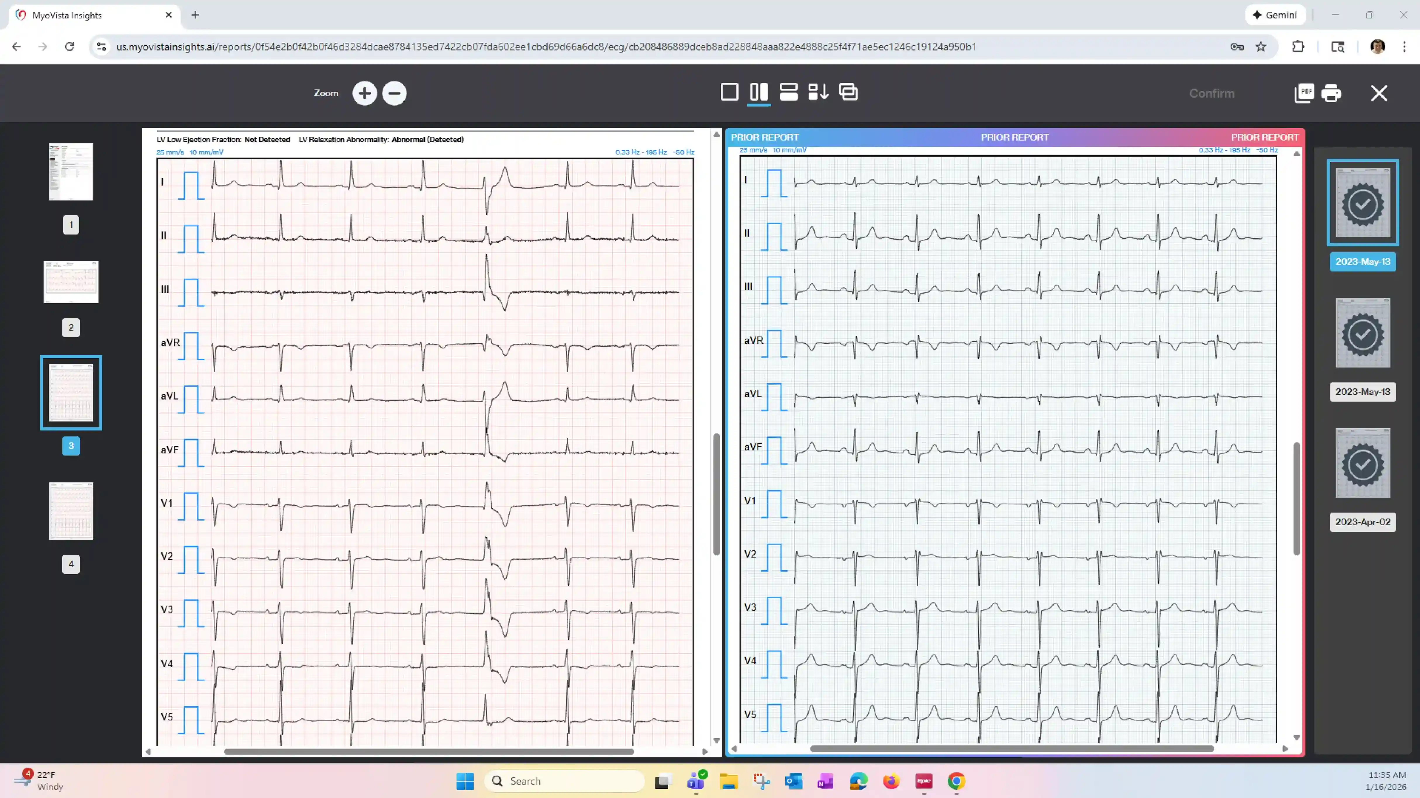 MyoVista® Insights™ Dashboard - AI-ECG Analysis Interface
