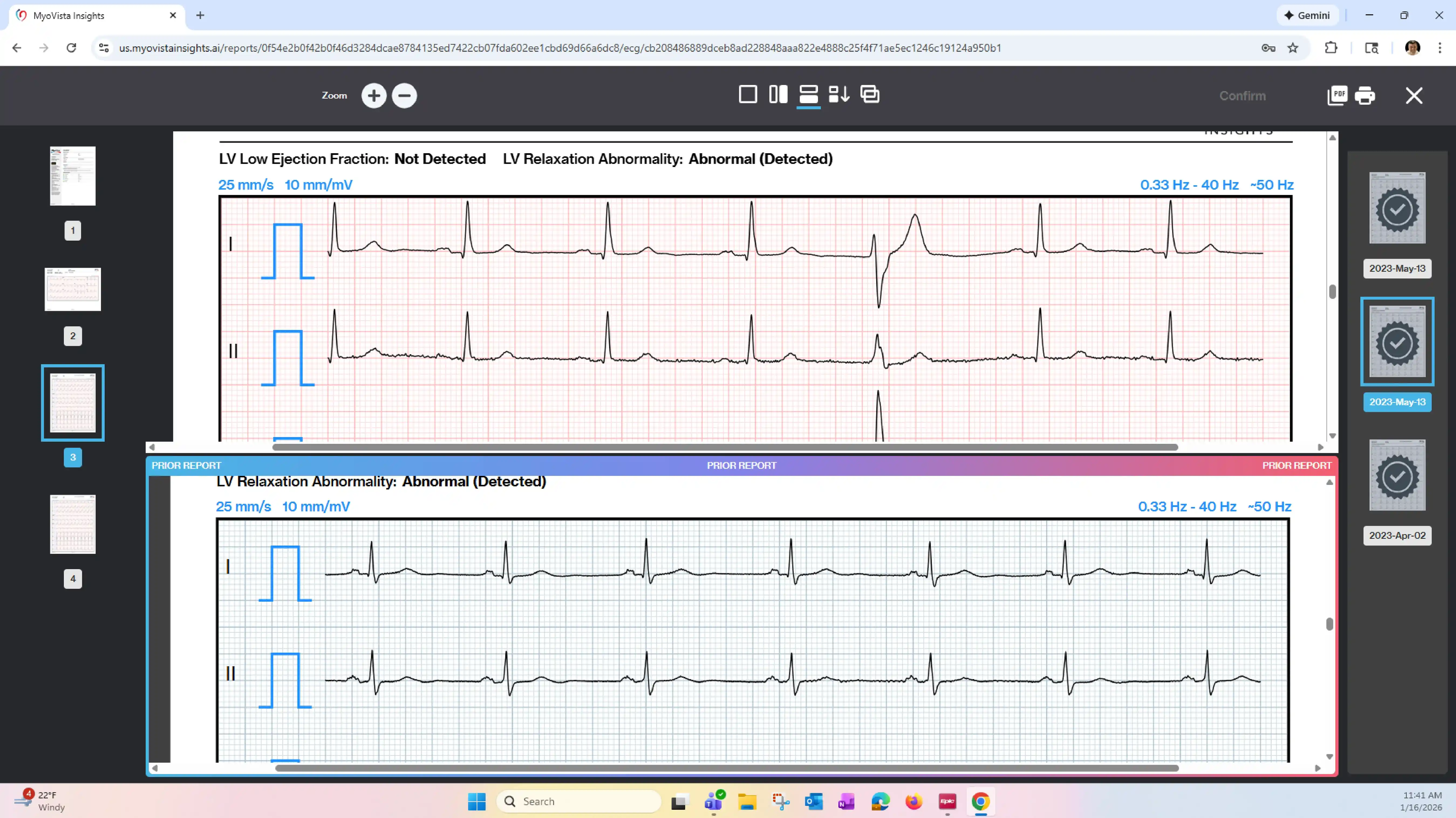 MyoVista® Insights™ Platform - AI-ECG Analysis Dashboard